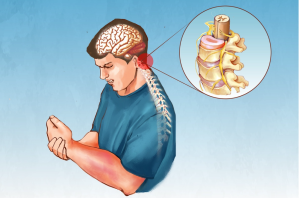 Complex Regional Pain Syndrome: Symptoms, Causes, Treatments, and Natural Approaches